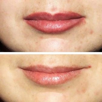 Можно ли убрать перманентный макияж губ
