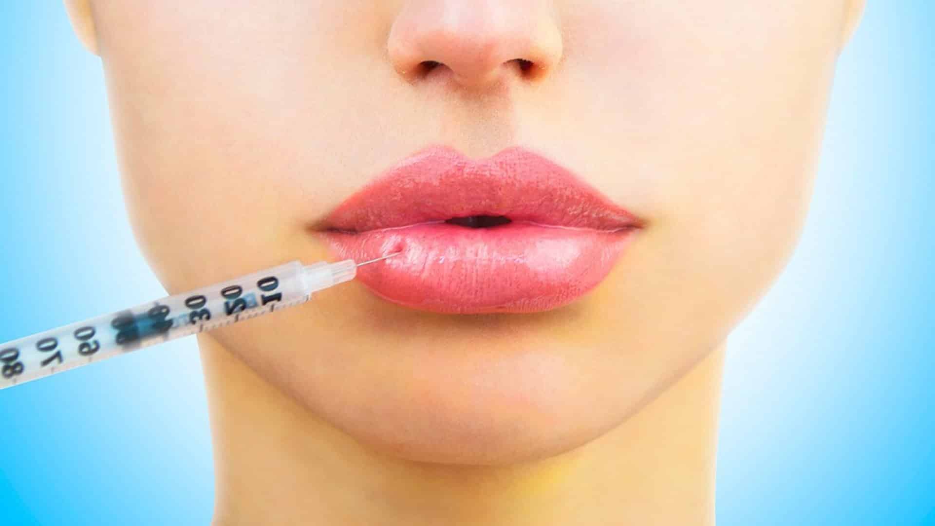 Увеличение губ с помощью гиалуроновой кислоты - болезненно 