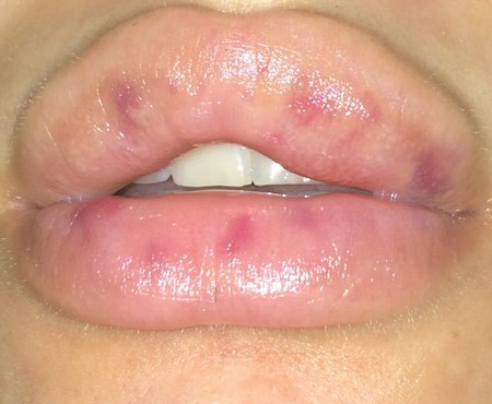 Возможные осложнения после инъекций для увеличения губ 