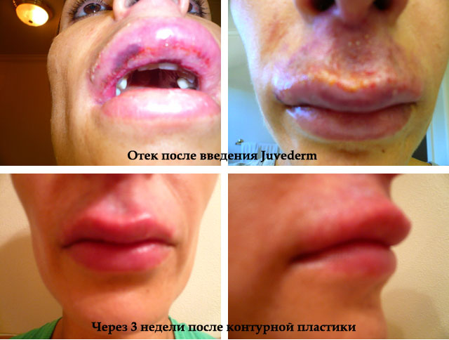 Возможные осложнения после введения объема губ 