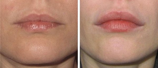 Фотографии до и после процедуры увеличения губ гиалуроновой кислотой 1 мл 