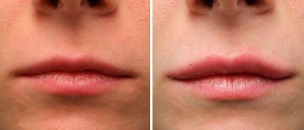 Увеличение губ гиалуроновой кислотой 1 мл до и после фото 