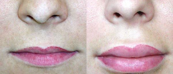 Увеличение губ с помощью гиалуроновой кислоты 1 мл до и после фото 