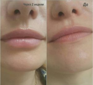 Увеличение губ гиалуроновой кислотой 1 мл, до и после. 