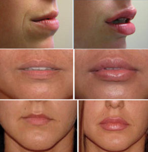 Фотографии до и после процедуры увеличения губ филлером на основе гиалуроновой кислоты 1 мл 