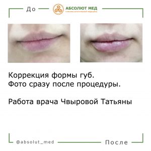 до и после коррекции губ 