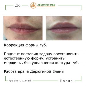 эффект до и после увеличения губ 
