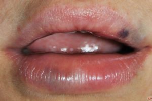 Как выглядит мазок после процедуры увеличения губ с помощью гиалуроновой кислоты? 
