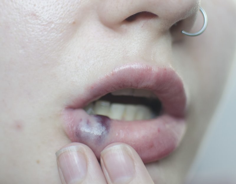 Что такое мазок на губах после аугментации гиалуроновой кислотой? 