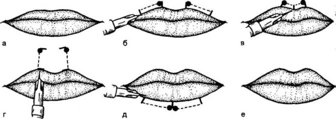 Парижская техника коррекции губ.