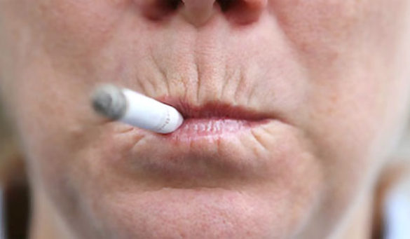 Морщины курильщика на верхней губе